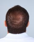 After Hair Transplant&nbsp;Midscalp